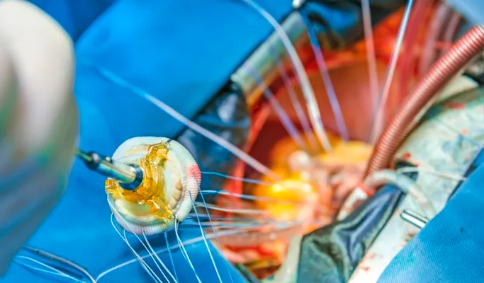 درمان روماتیسم قلبی به روش جراحی