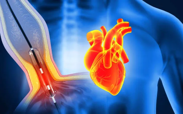 چه کسانی به آنژیوپلاستی نیاز دارند